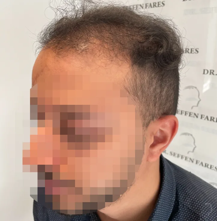 Patient 69, avant greffe de cheveux