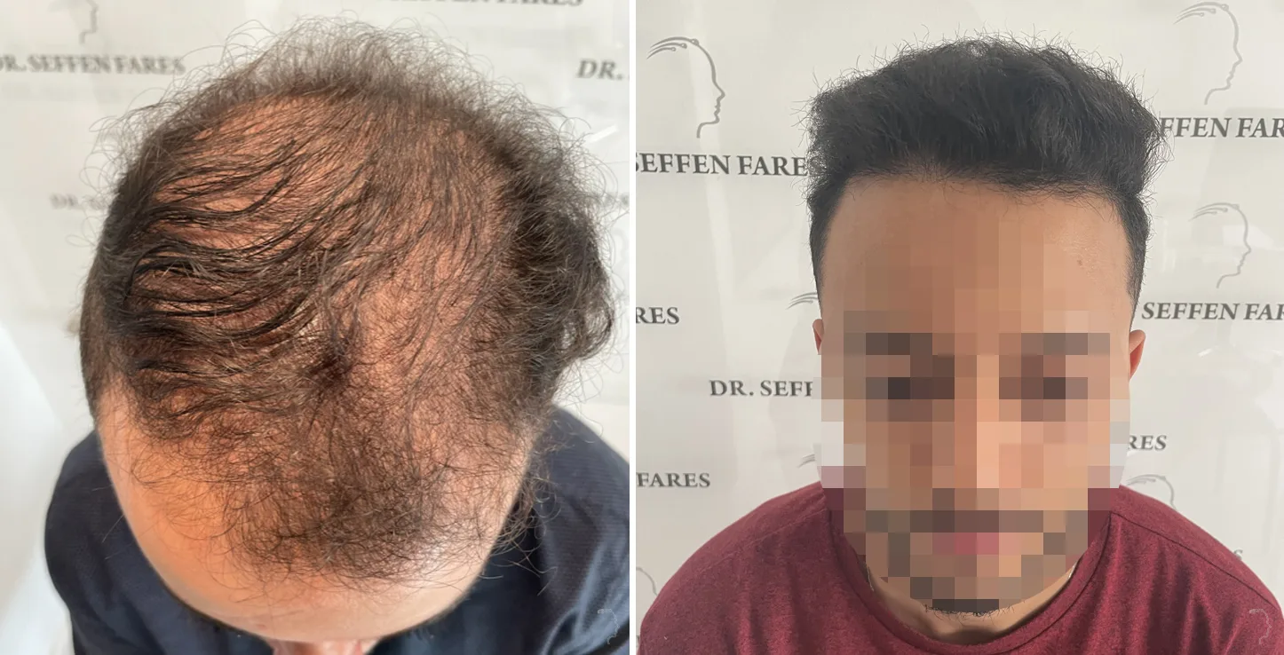 Patient 69, before and after hair transplant, view 2