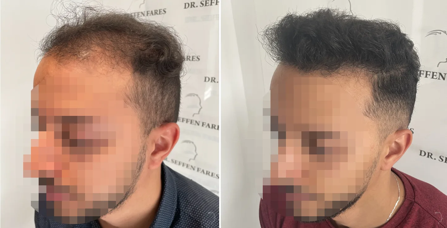 Patient 69, avant et après greffe de cheveux, vue 1