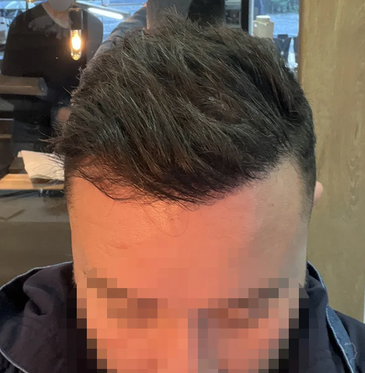 Patient 70, après greffe de cheveux