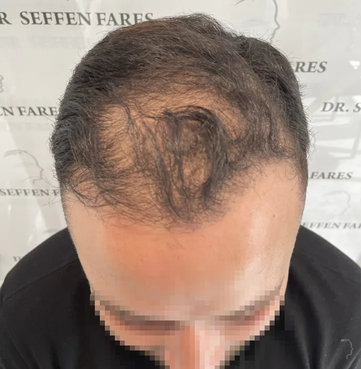 Patient 70, avant greffe de cheveux
