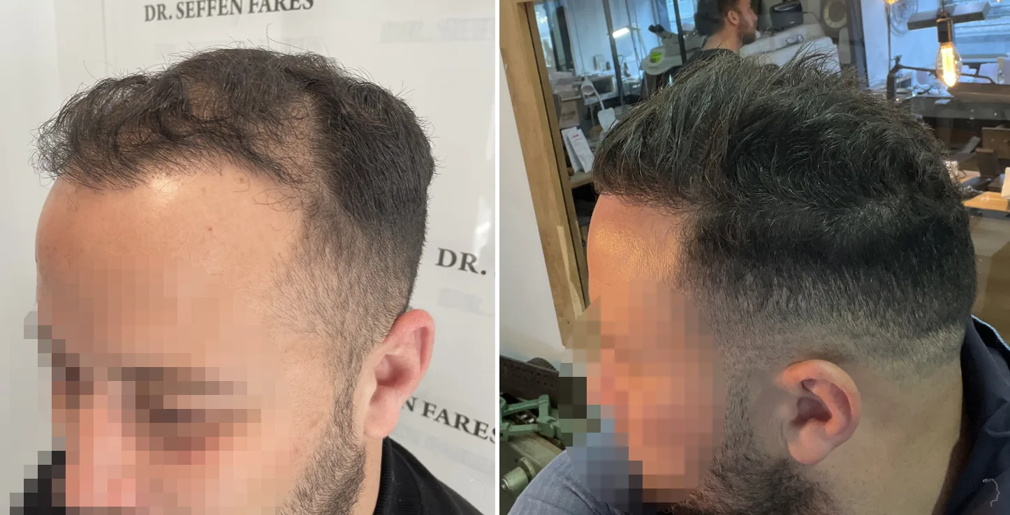 Patient 70, before and after hair transplant, view 2