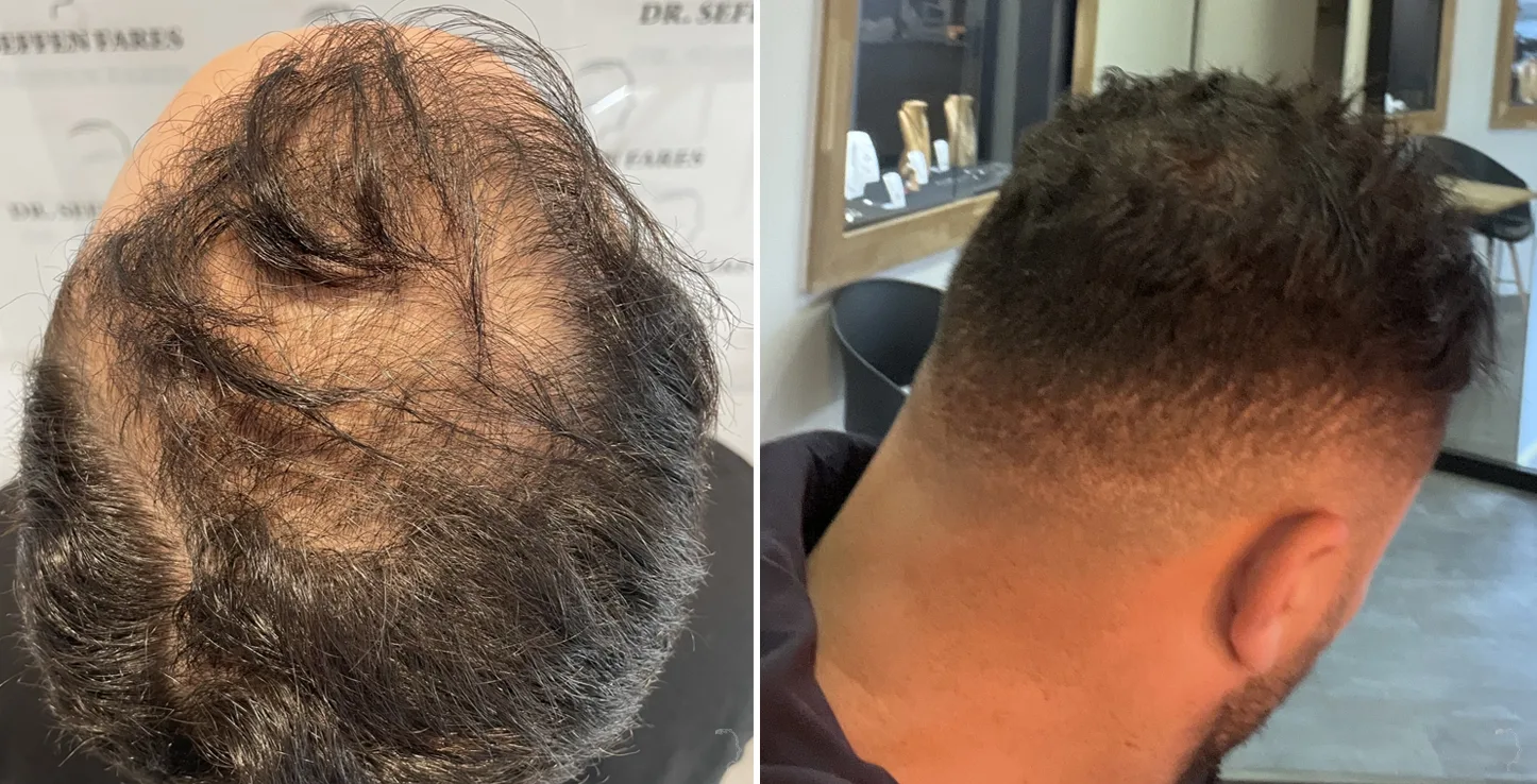 Patient 70, before and after hair transplant, view 3