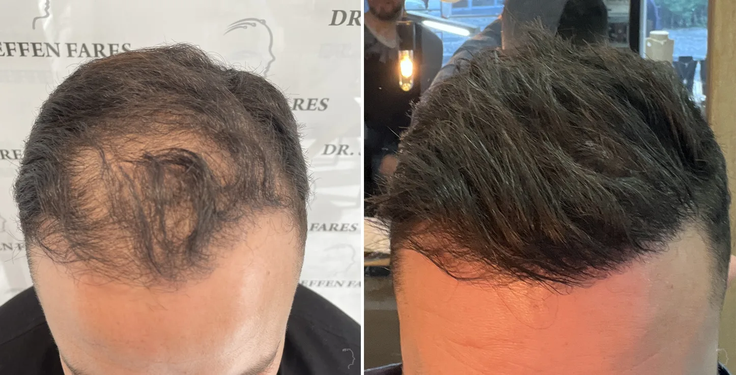 Patient 70, before and after hair transplant, view 1