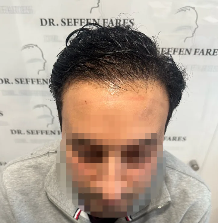 Patient 71, après greffe de cheveux