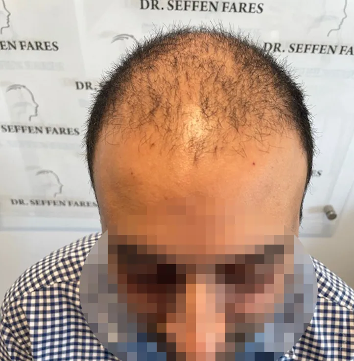 Patient 71, avant greffe de cheveux