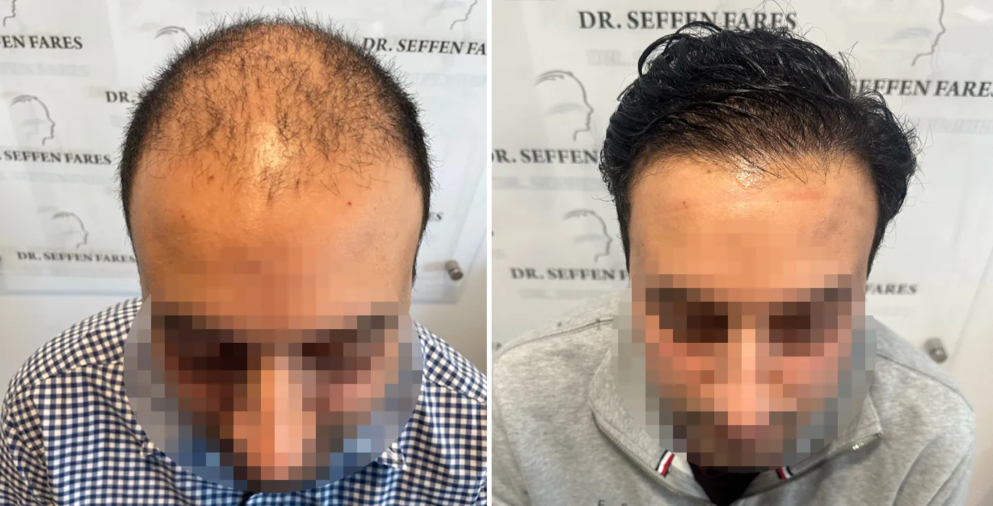 Patient 71, before and after hair transplant, view 2