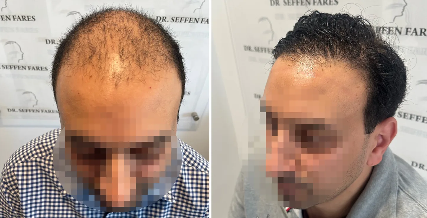 Patient 71, before and after hair transplant, view 3