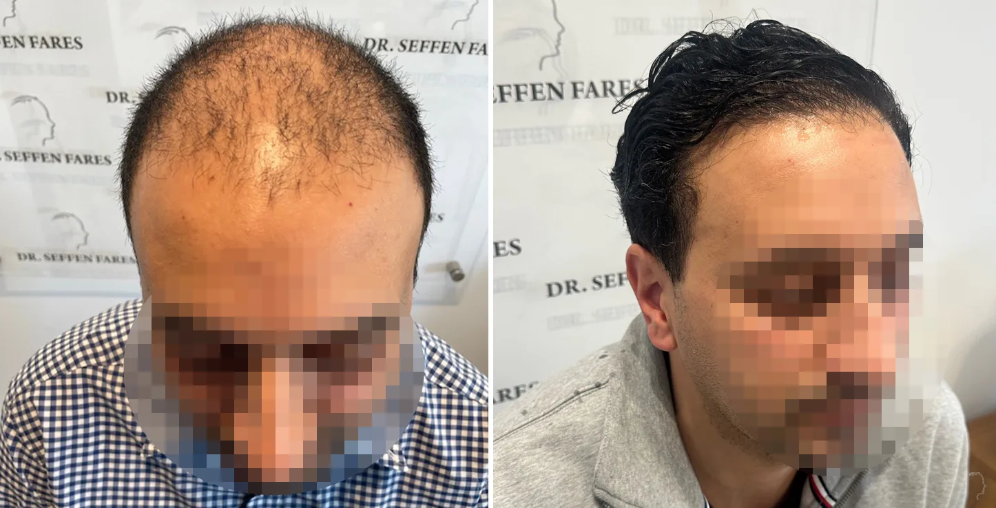Patient 71, before and after hair transplant, view 4