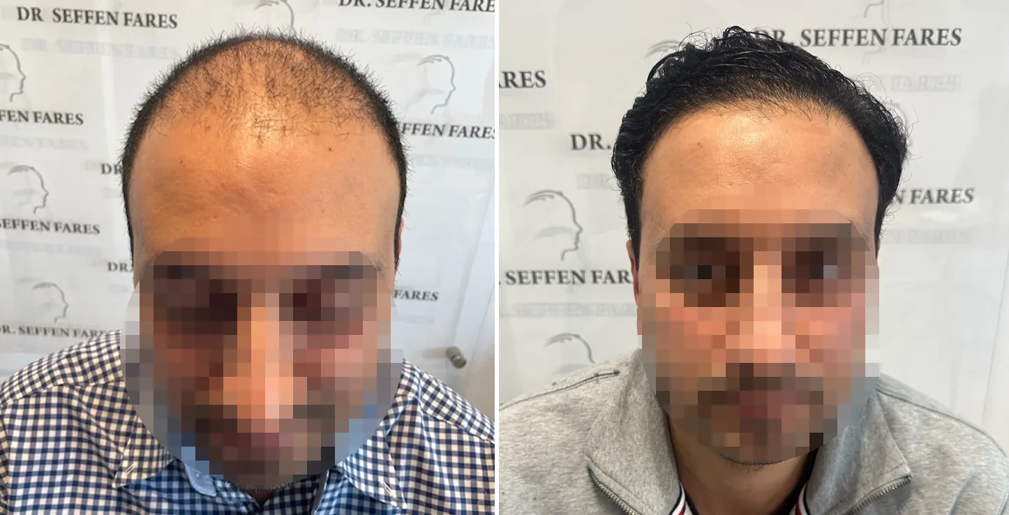Patient 71, before and after hair transplant, view 1