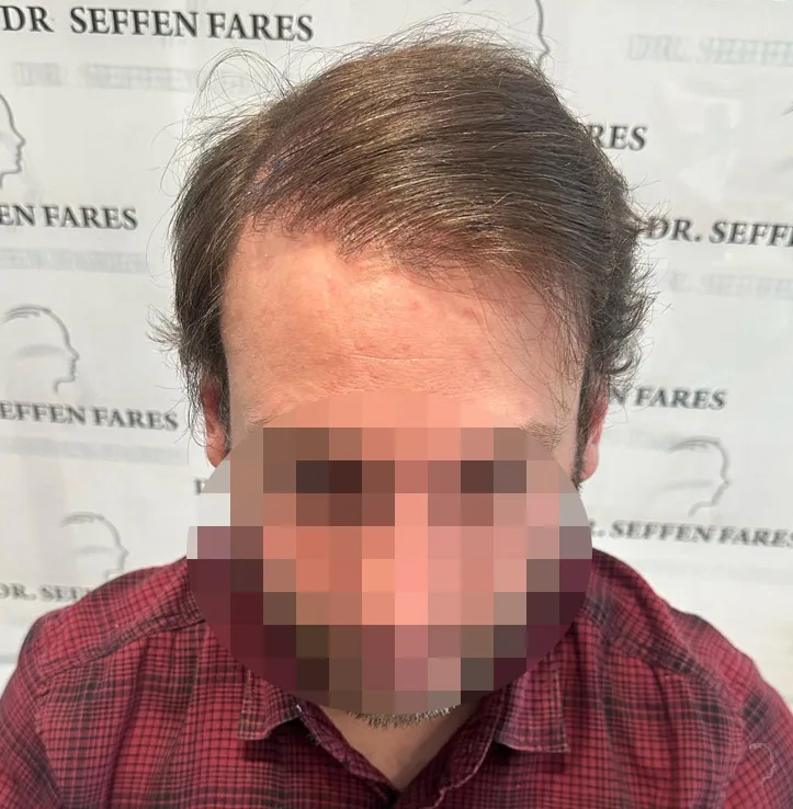 Patient 72, après greffe de cheveux