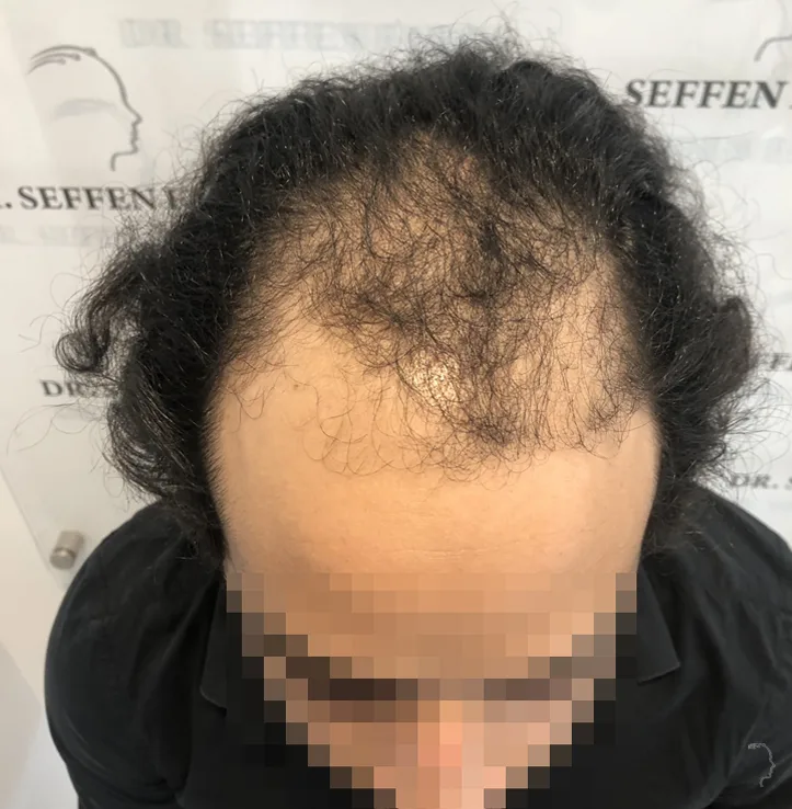 Patient 73, après greffe de cheveux