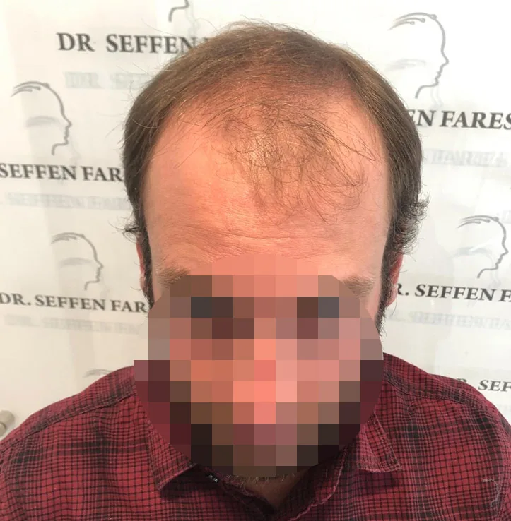 Patient 72, avant greffe de cheveux