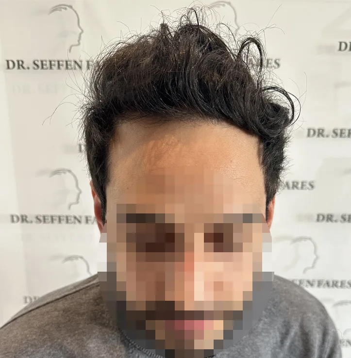 Patient 73, avant greffe de cheveux