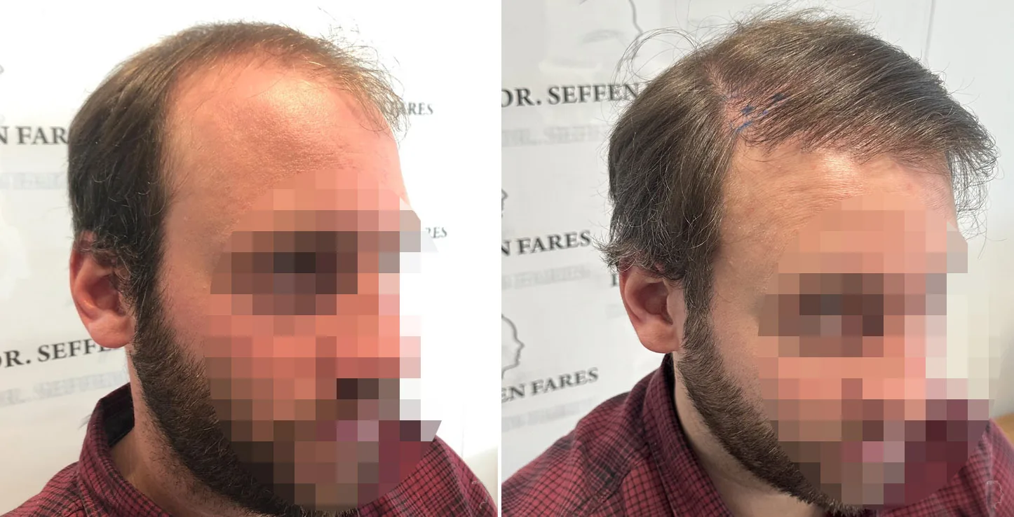 Patient 72, before and after hair transplant, view 2