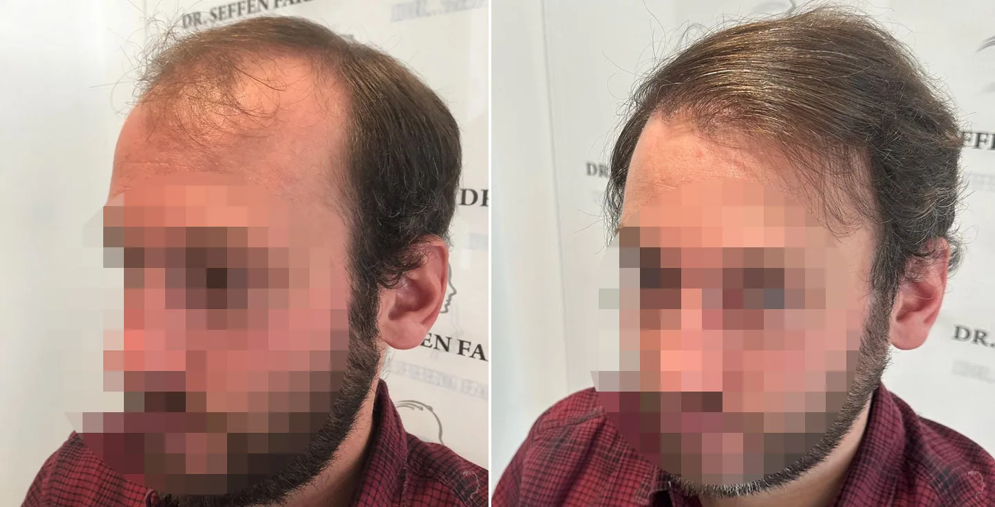 Patient 72, before and after hair transplant, view 3