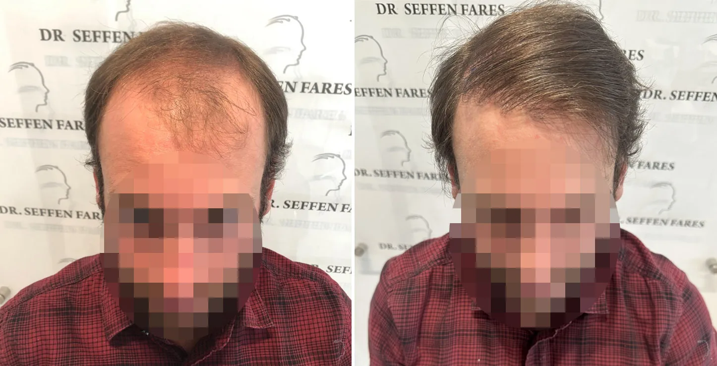 Patient 72, before and after hair transplant, view 1