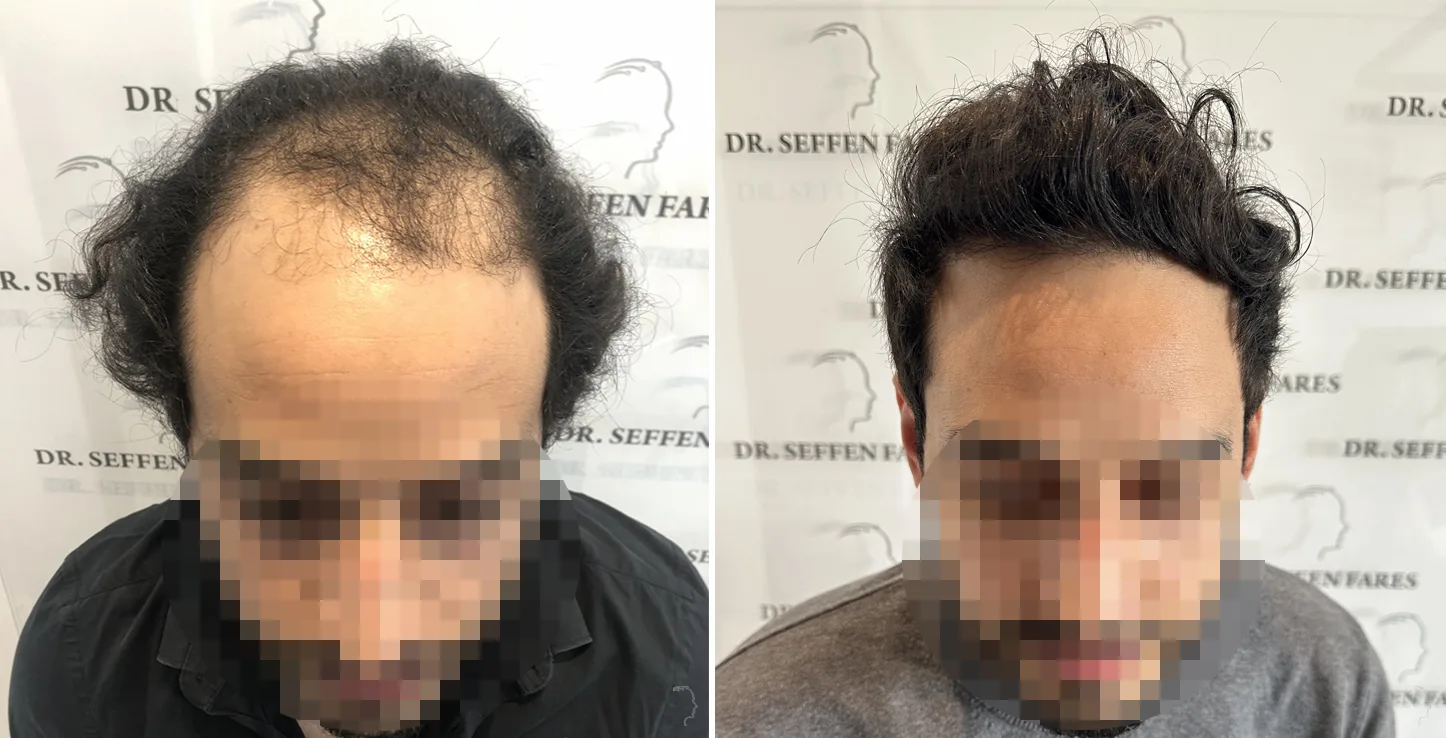 Patient 73, before and after hair transplant, view 1