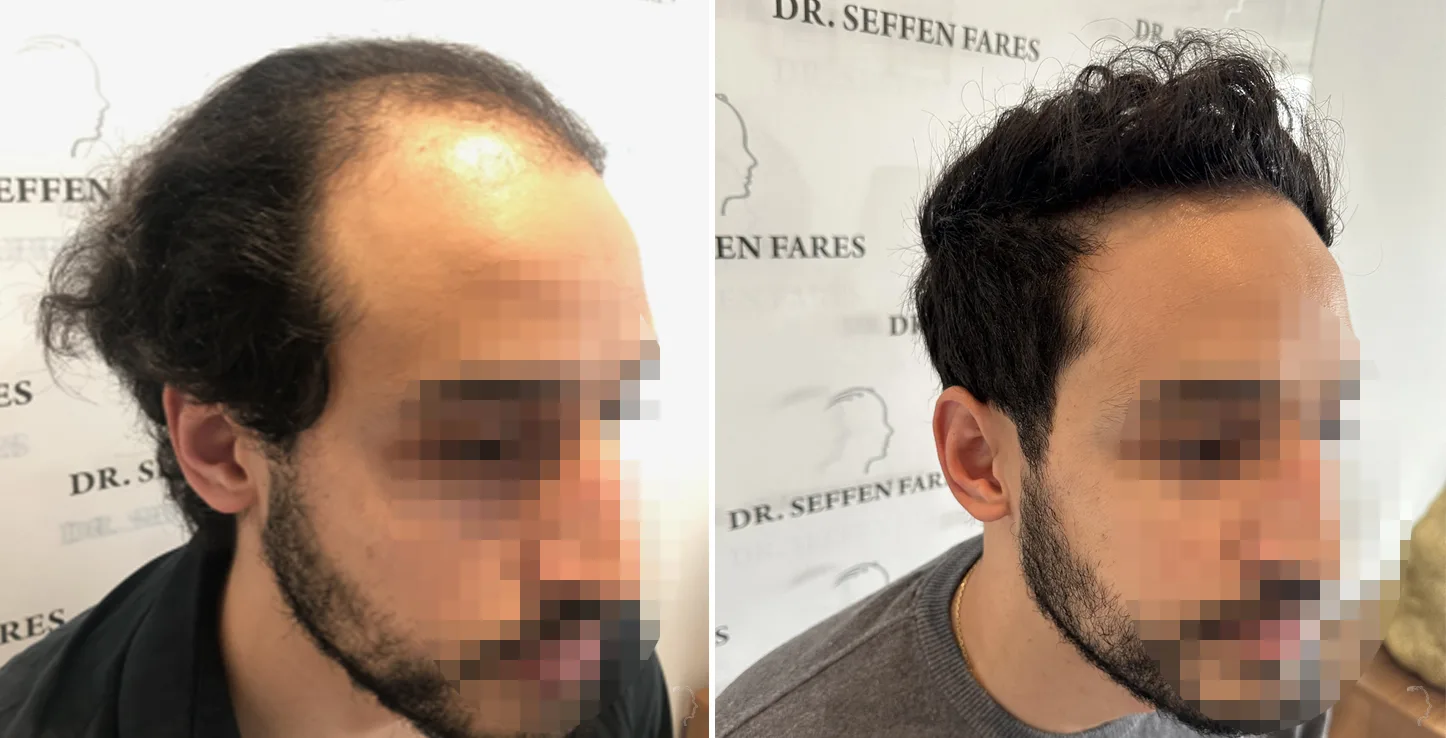 Patient 73, before and after hair transplant, view 3