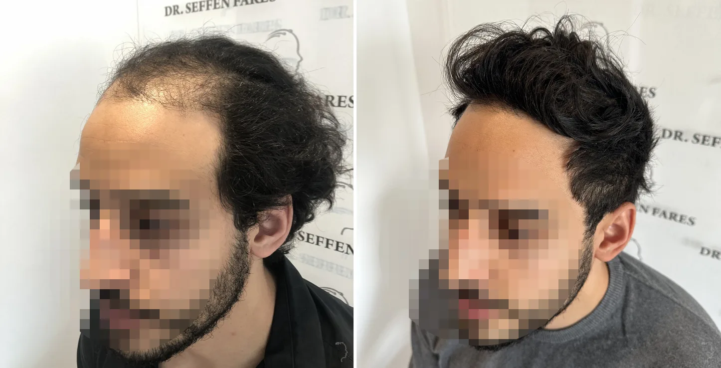 Patient 73, before and after hair transplant, view 2