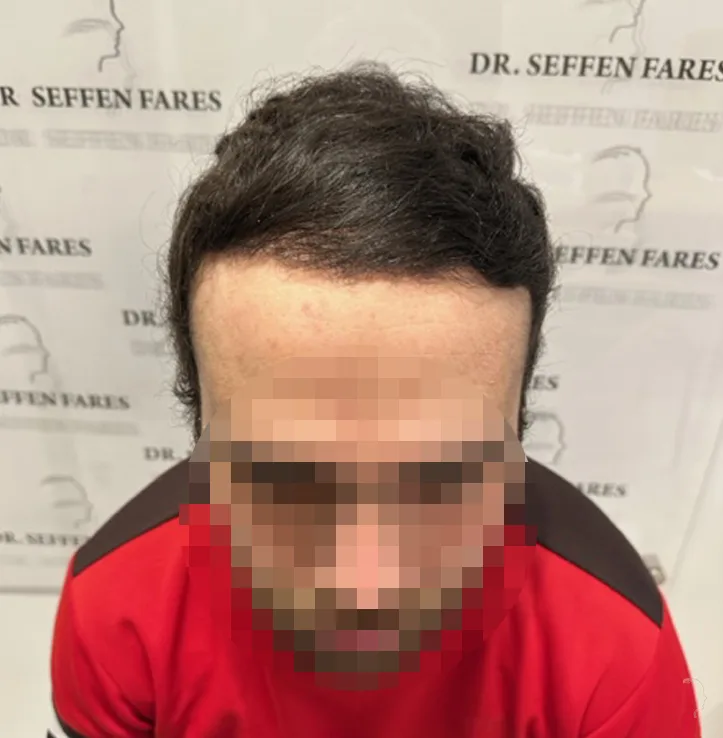 Patient 74, après greffe de cheveux