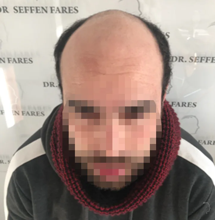 Patient 74, avant greffe de cheveux