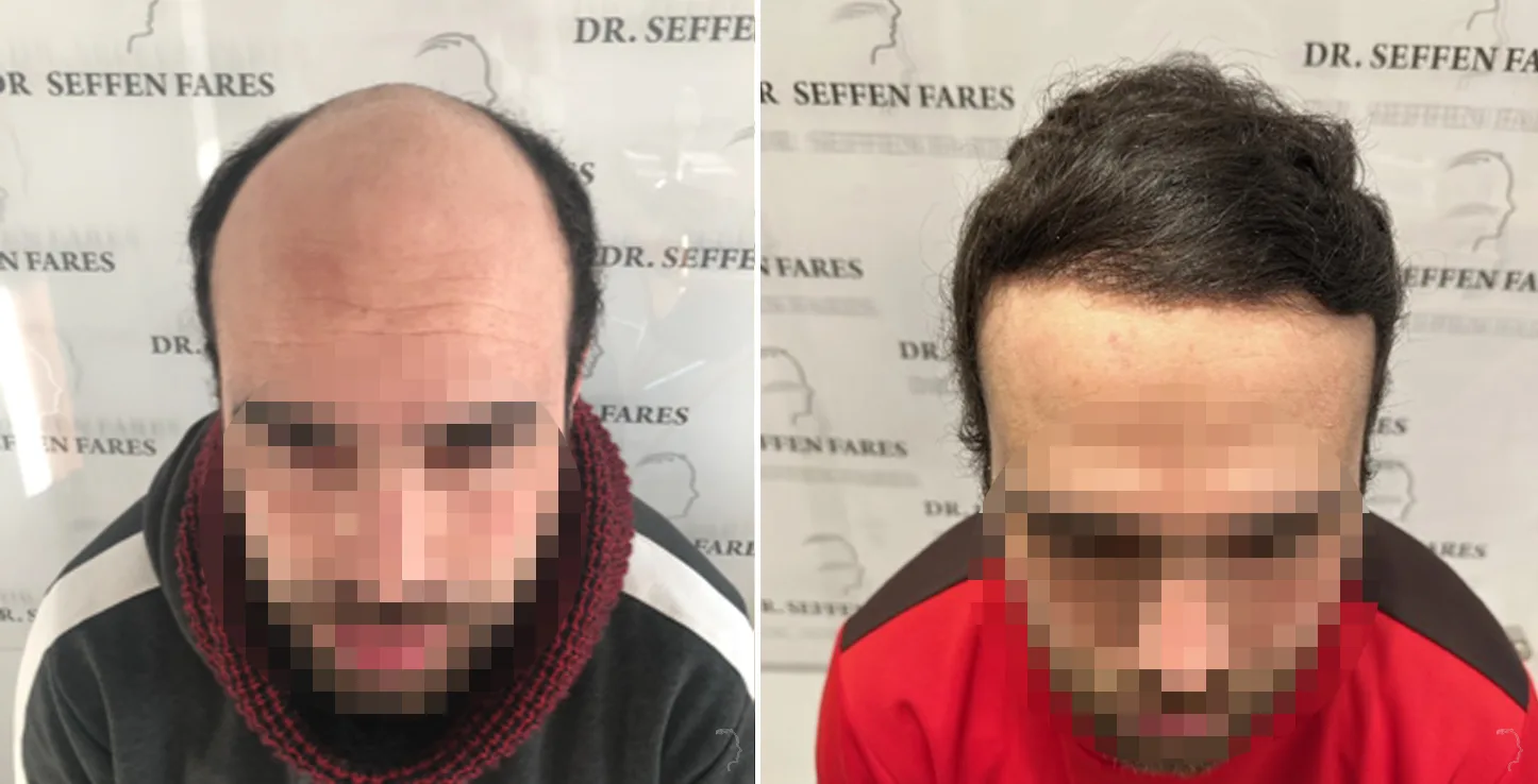 Patient 74, before and after hair transplant, view 4