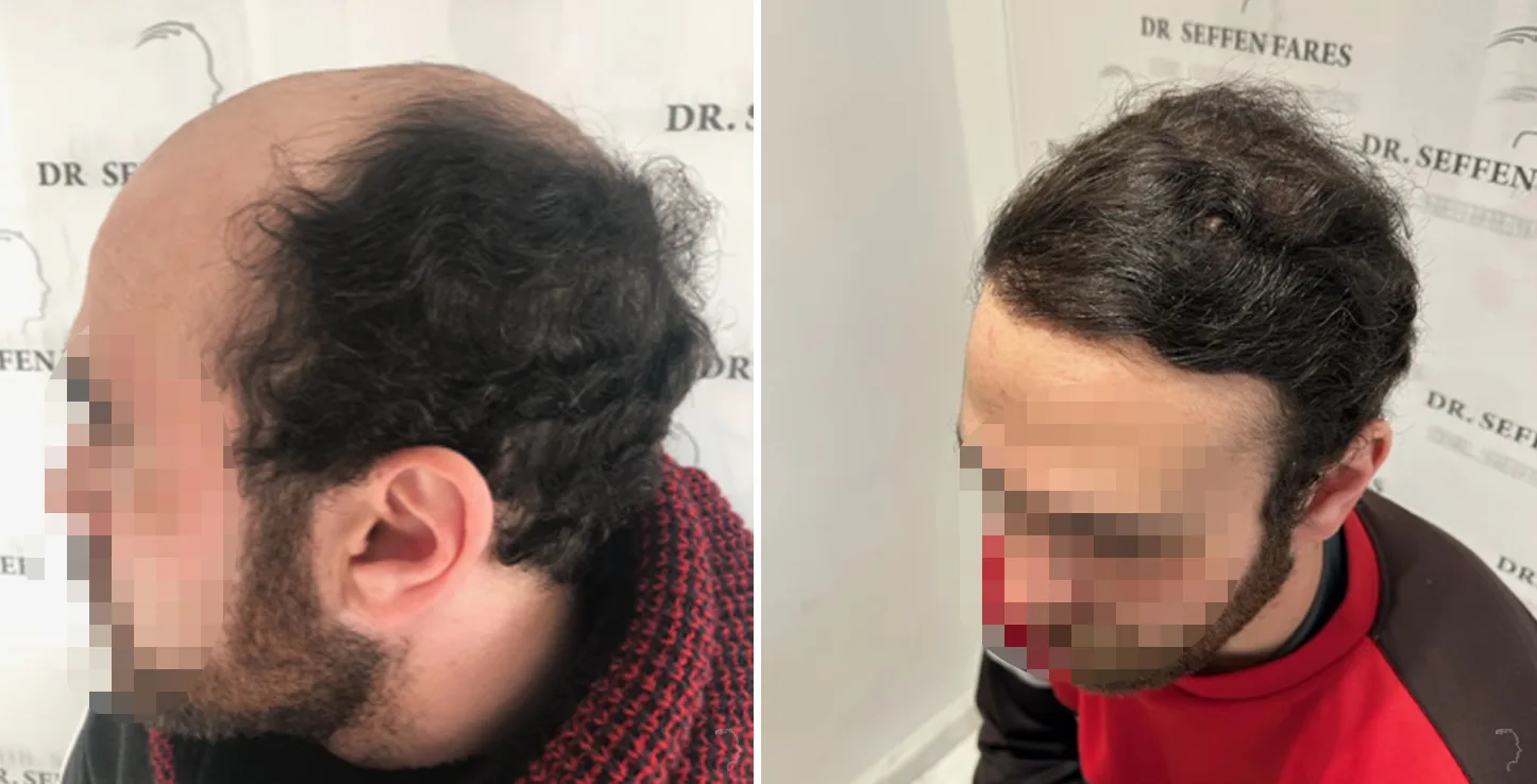 Patient 74, before and after hair transplant, view 2