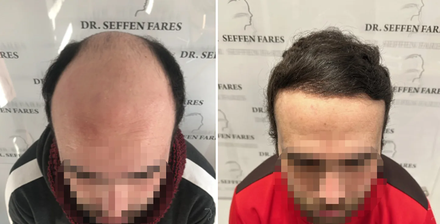 Patient 74, before and after hair transplant, view 1