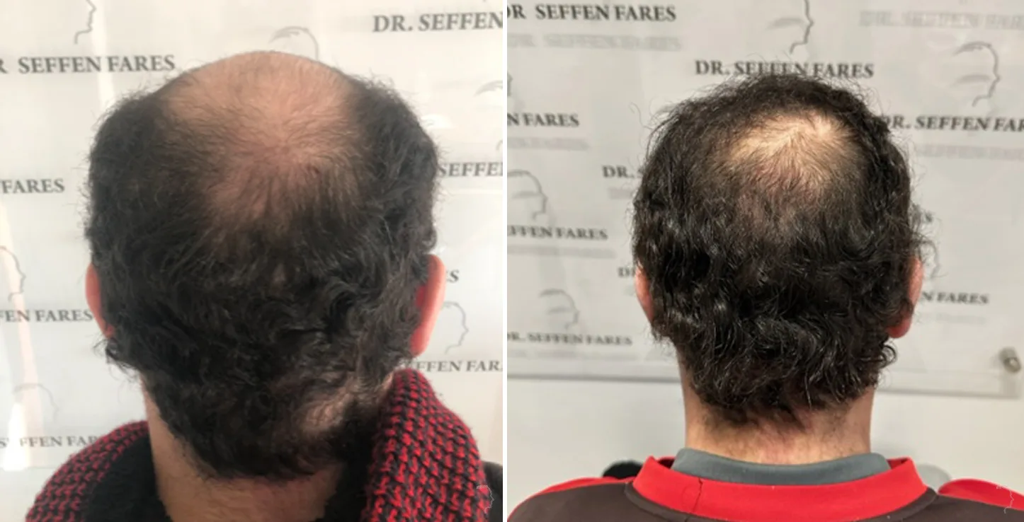 Patient 74, before and after hair transplant, view 3