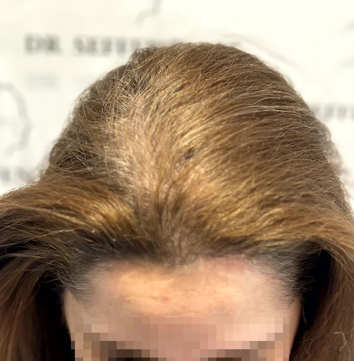 Après greffe de cheveux
