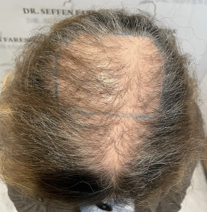 Avant greffe de cheveux