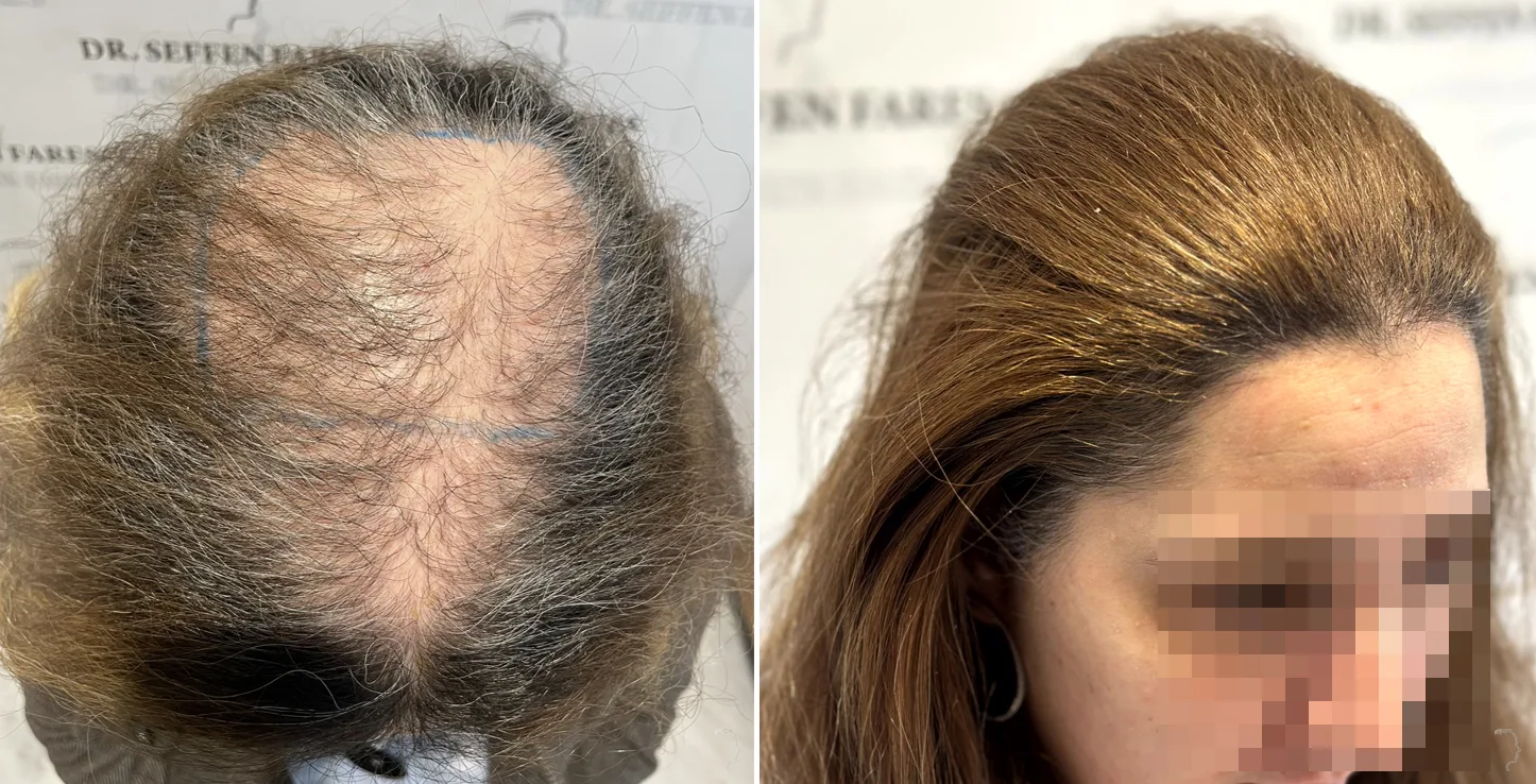 Patient 75, avant et après greffe de cheveux, vue 3