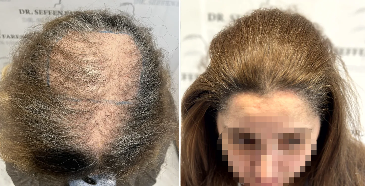 Patient 75, avant et après greffe de cheveux, vue 2