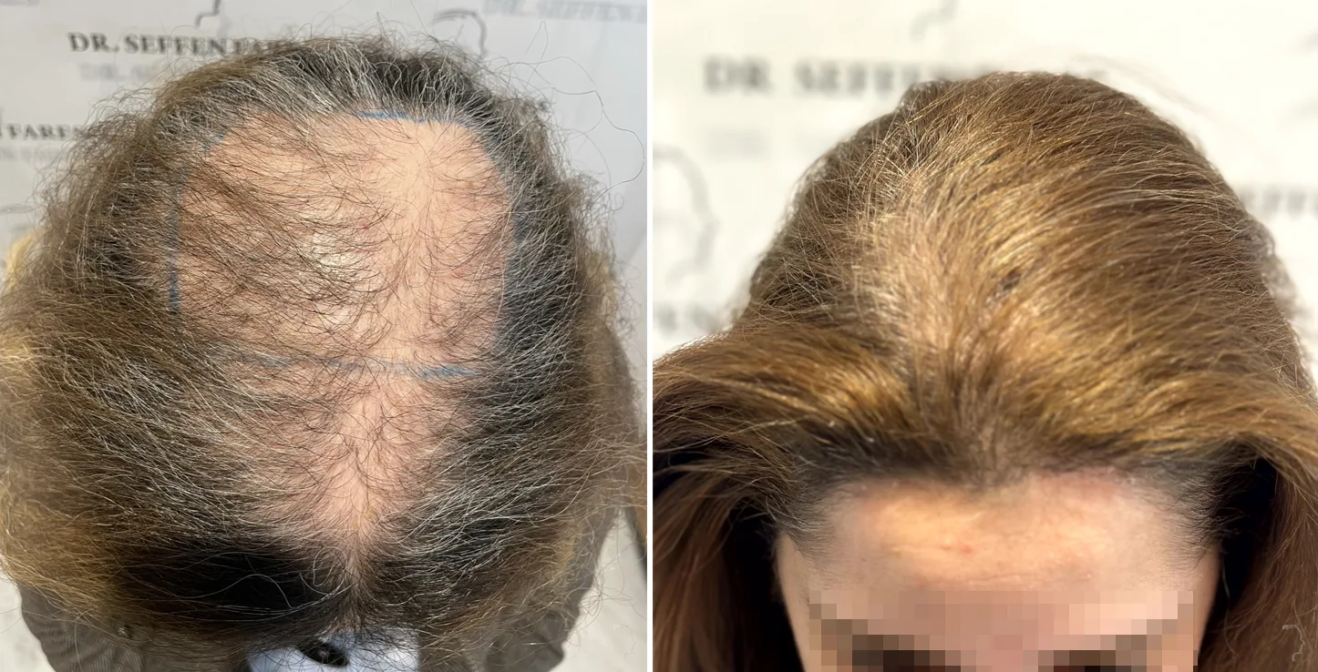 Patient 75, before and after hair transplant, view 1