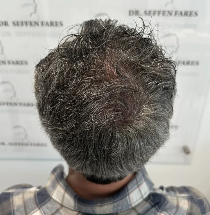 Patient 76, après greffe de cheveux