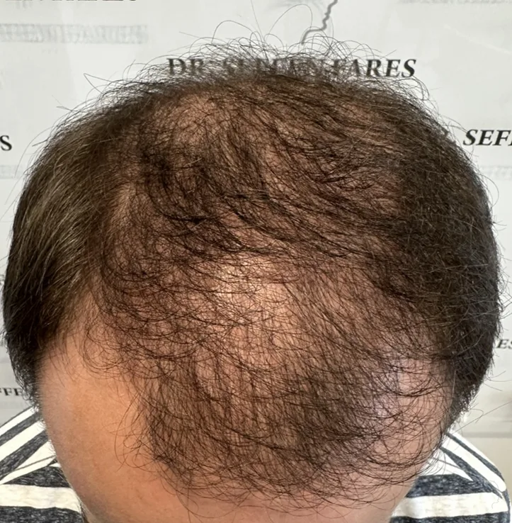 Patient 77, après greffe de cheveux