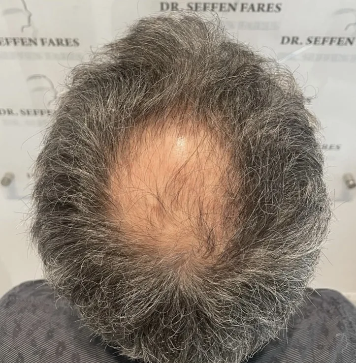 Patient 76, avant greffe de cheveux
