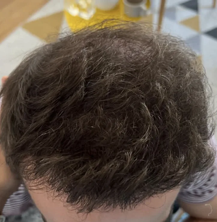 Patient 77, avant greffe de cheveux