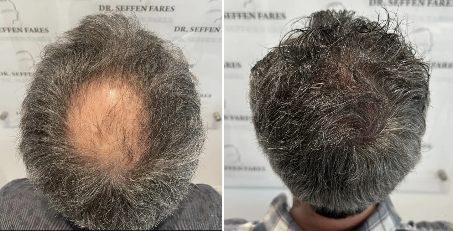 Patient 76, before and after hair transplant, view 1