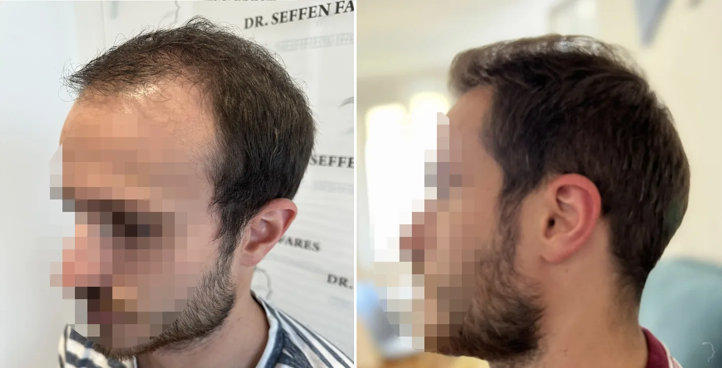 Patient 77, before and after hair transplant, view 3