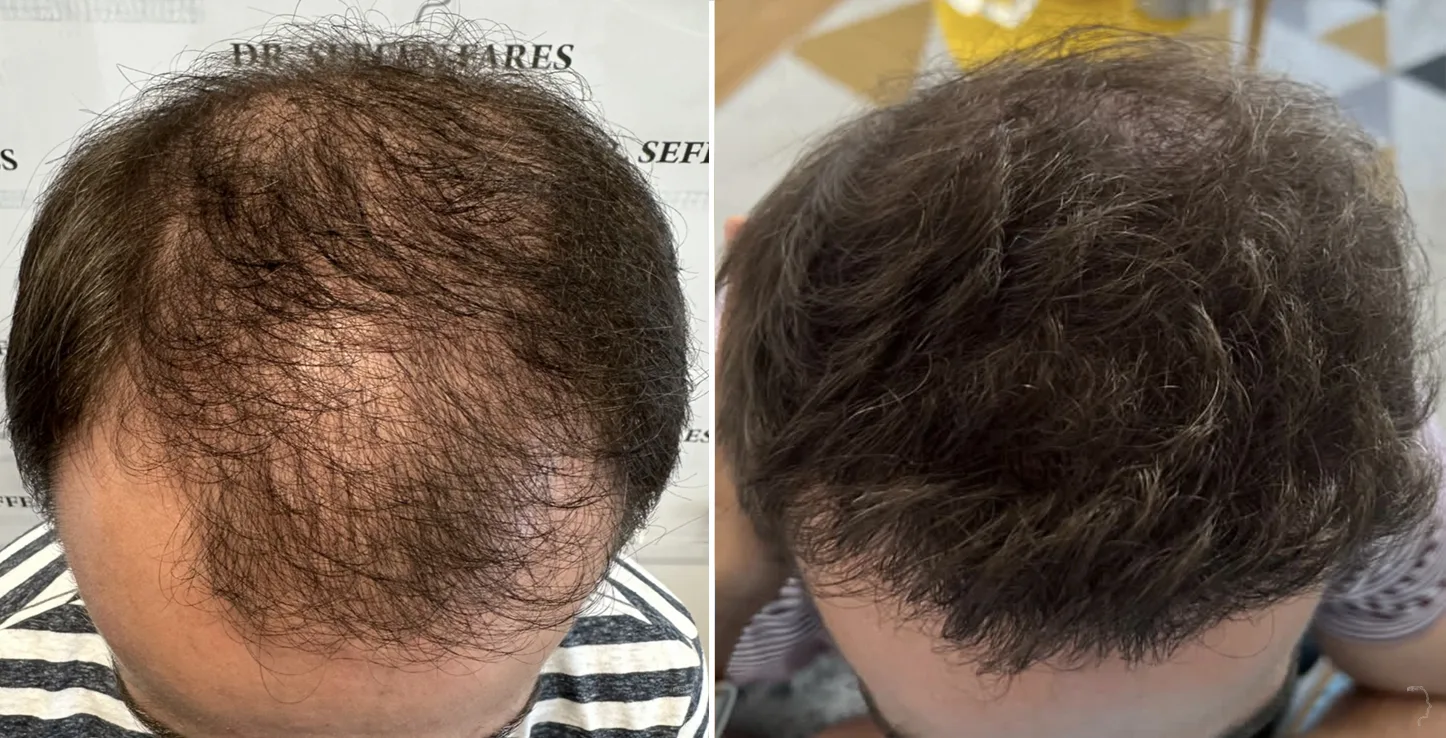 Patient 77, before and after hair transplant, view 2
