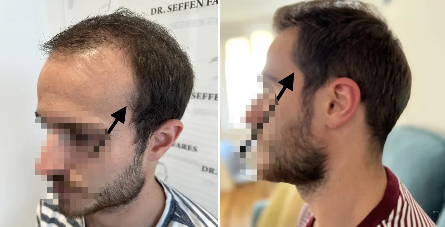 Patient 77, before and after hair transplant, view 4