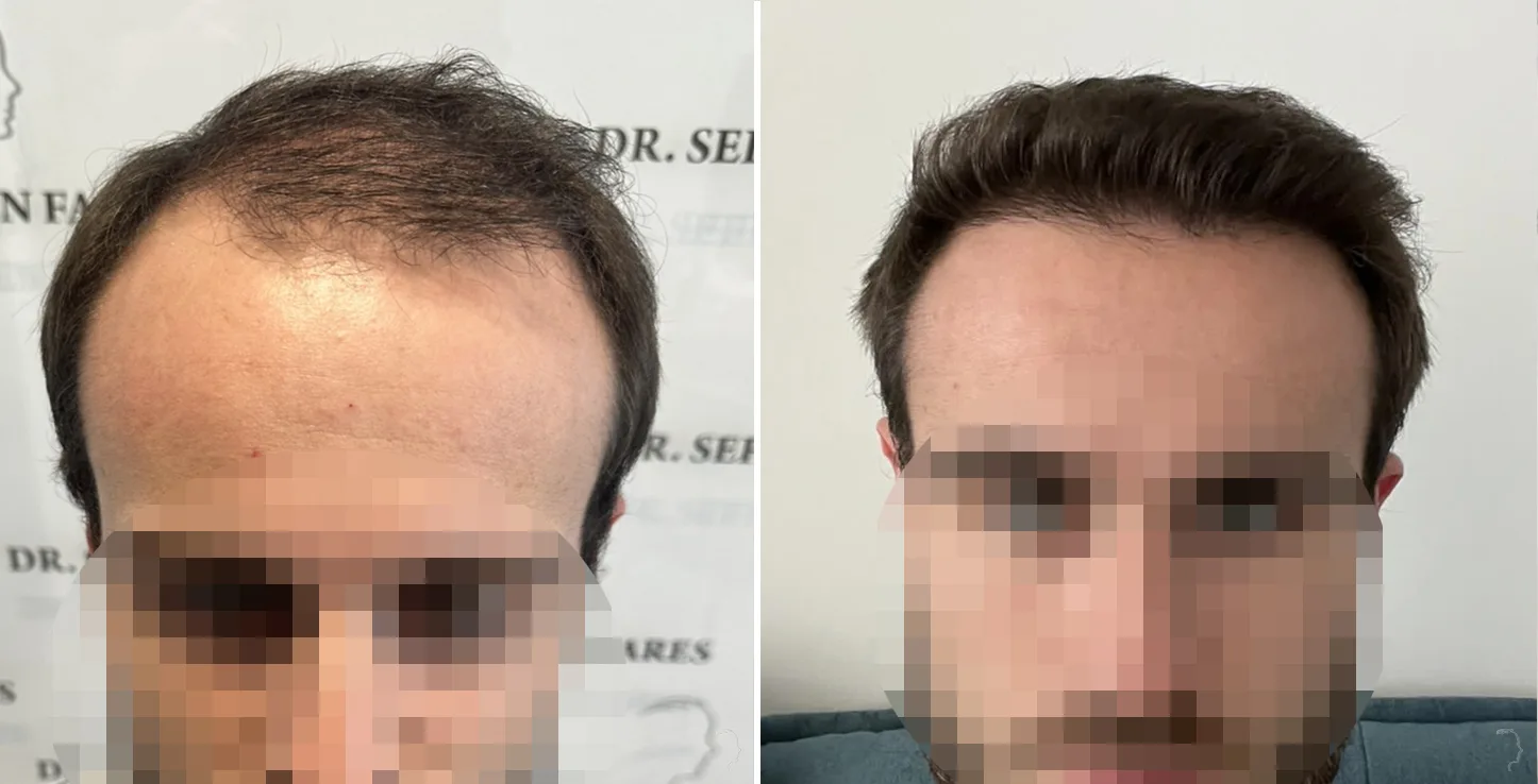 Patient 77, before and after hair transplant, view 1