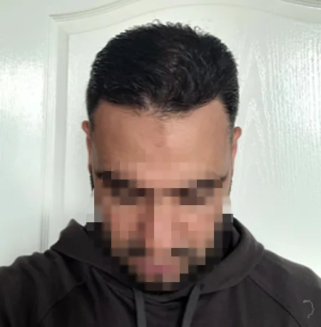 Patient 78, après greffe de cheveux