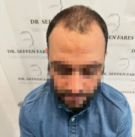 Patient 78, avant greffe de cheveux