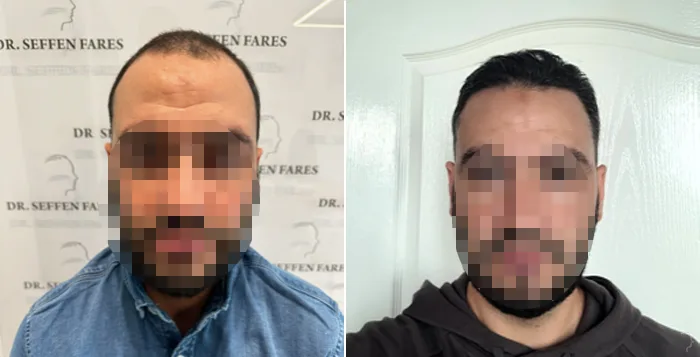 Patient 78, before and after hair transplant, view 2