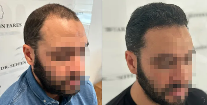 Patient 78, before and after hair transplant, view 4