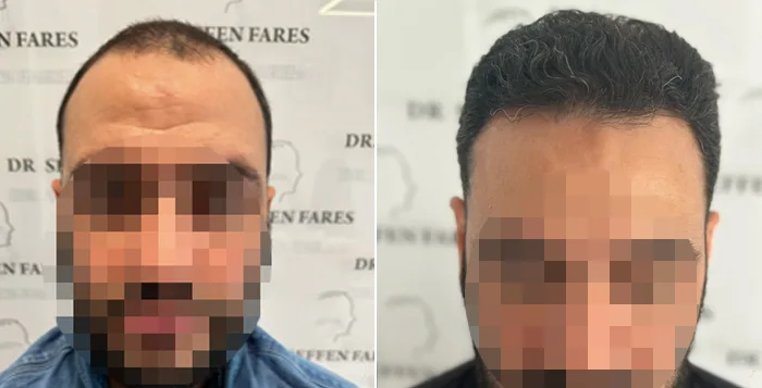 Patient 78, before and after hair transplant, view 3