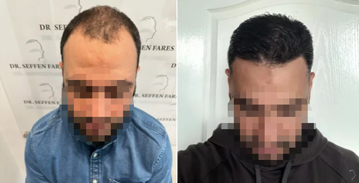 Patient 78, before and after hair transplant, view 1